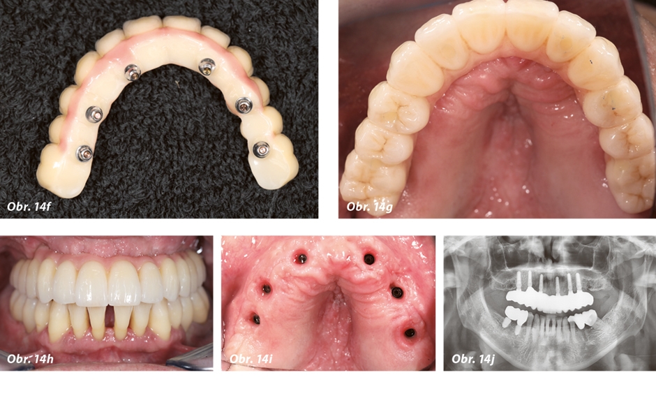 Obr. 14f–j: Výsledné práce in situ (protetické práce zhotovil Andrea Rosinski, DentalConcept, Berlín, Německo).