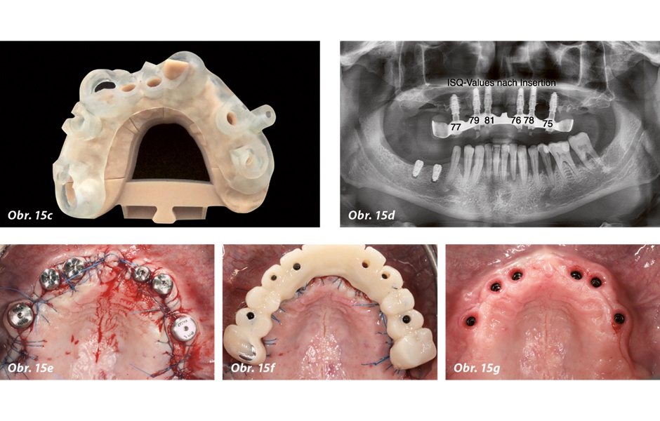 Obr. 15a–g: U 49letého pacienta se objevilo rozsáhlé onemocnění parodontu. Diagnóza byla jasná: extrakce všech horních zubů.
