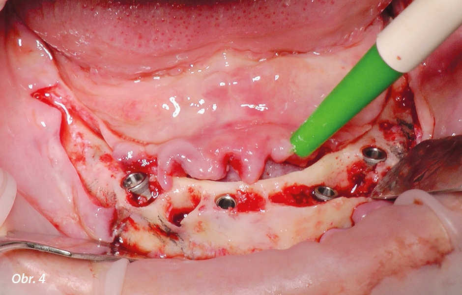 Čtyři zavedené implantáty Max Stability: jeden o Ø 4,5 mm, délky 14 mm v poloze 44 a další tři o Ø 3,75 mm, délky 14 mm v poloze 42 a 34 a délky 12 mm v poloze 32.