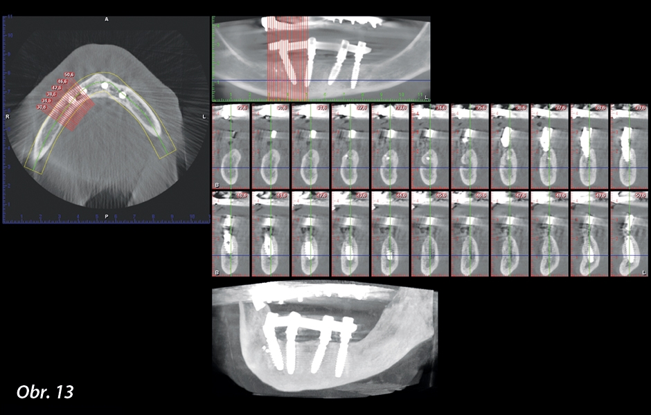 CBCT s odstupem 7 měsíců po chirurgickém zákroku.