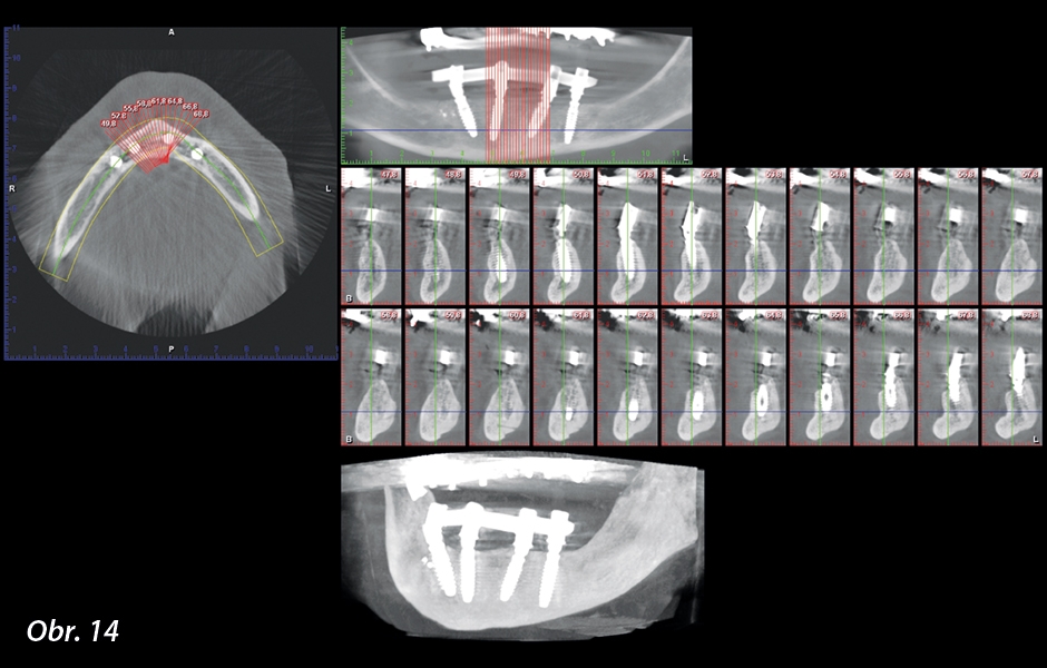 CBCT s odstupem 7 měsíců po chirurgickém zákroku.