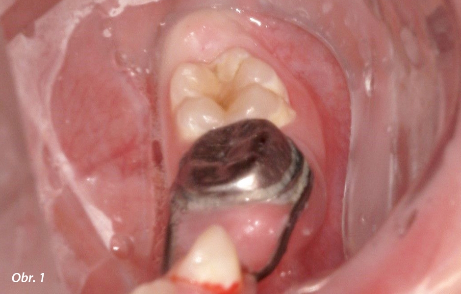 Zub 36 před ošetřením.