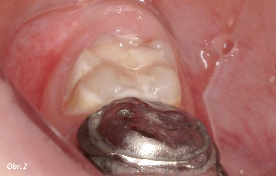 Zub 46 před ošetřením.