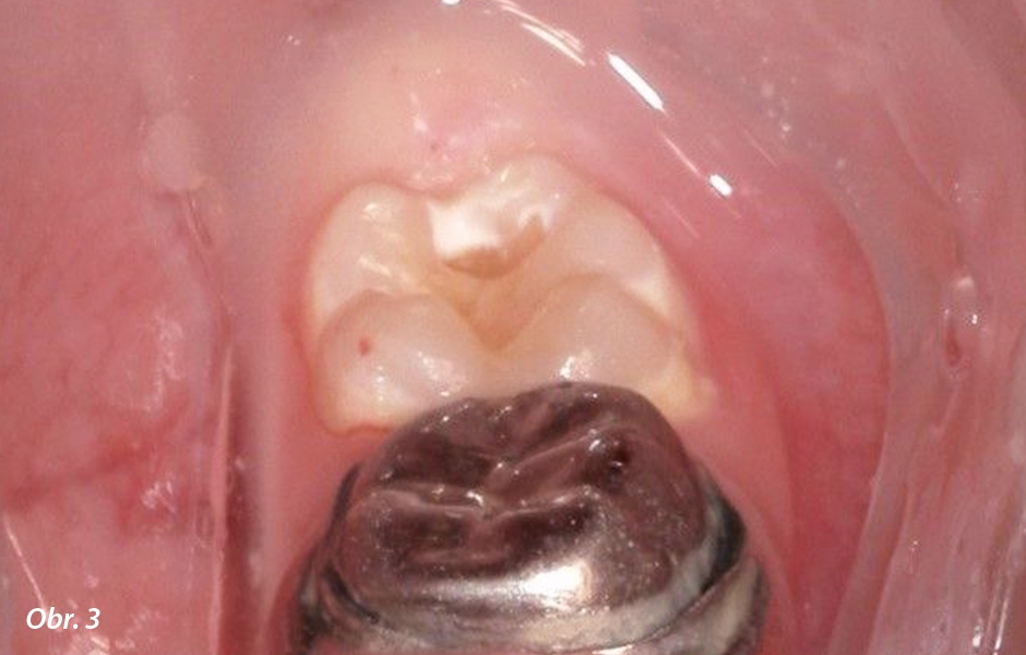 Začátek odstraňování zubního kazu u zubu 36.