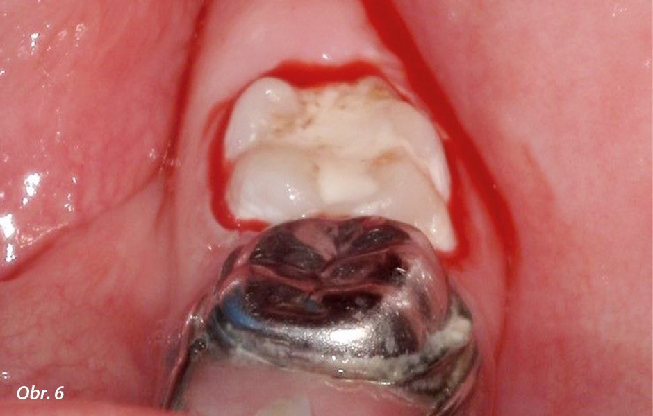 Zub 36 před úpravou okluze rekonstruovaný pomocí Riva Self Cure HV. Všimněte si podrážení dásní, je způsobeno odstraňováním přebytků skloionomeru karbidovým brouskem ve tvaru plamínku a nikoli nanesením Riva Star Aqua (zachyceno výše).