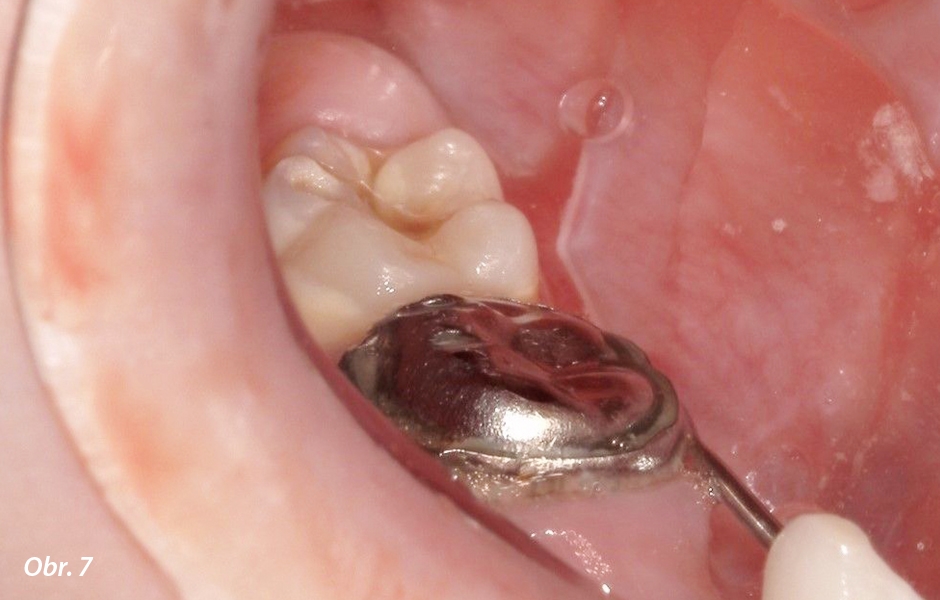 Zub 46 byl ošetřen naprosto stejným způsobem. Všimněte si estetického výsledku.