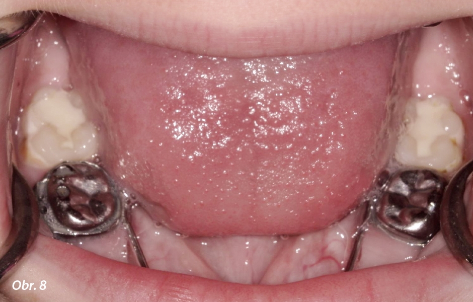 Zuby 36 a 46 dva týdny po ošetření vykazují estetický výsledek bez tmavého černého zabarvení.