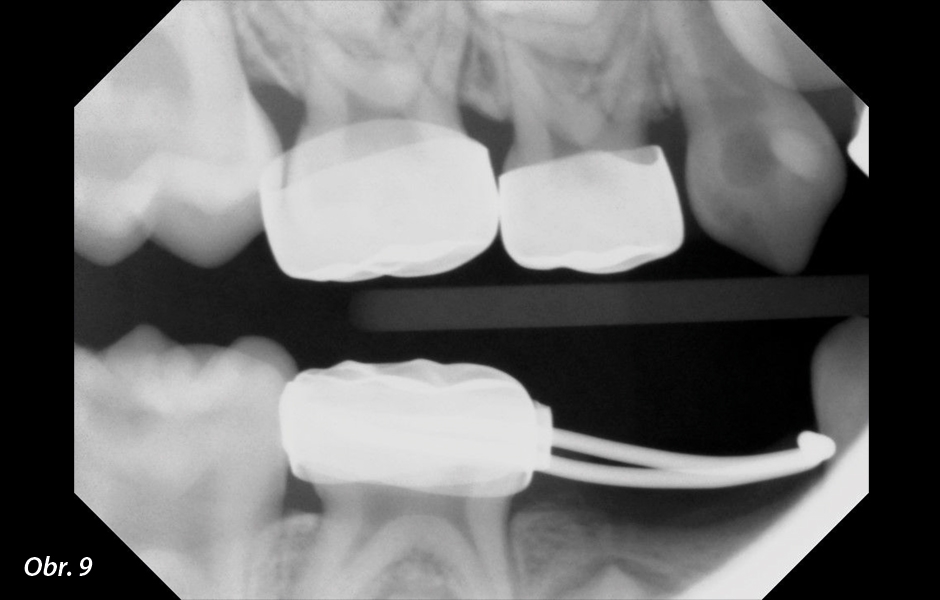  Bitewing RTG snímek pravé strany před ošetřením. Kaz je zřejmý u zubů 16, 53 a 46.