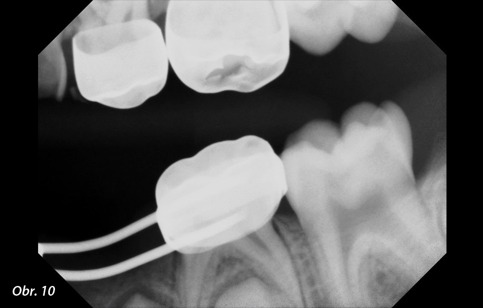 Bitewing RTG snímek levé strany před ošetřením. Kaz je zřejmý u zubů 63 a 36.
