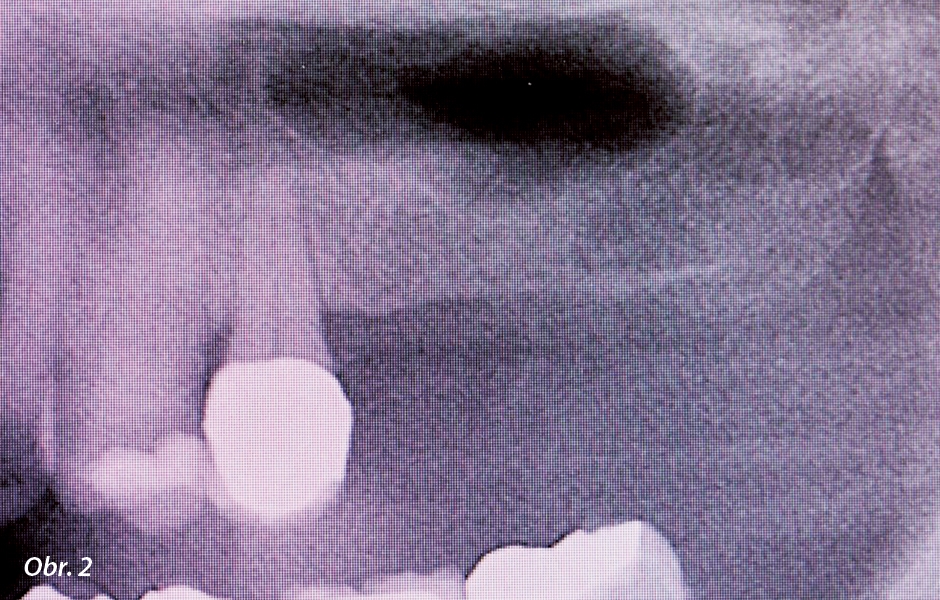 Detailní pohled na rentgenový snímek v oblasti 25, 26 a 27.