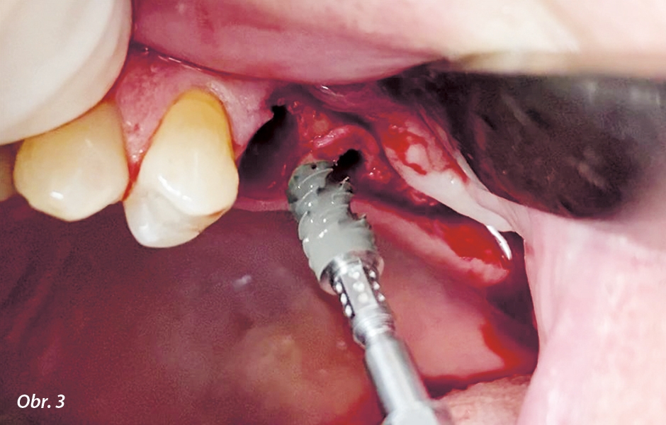 Implantát Straumann® BLX Ø 5.0 mm × 12 mm připravený k zavedení do oblasti zubu 25.
