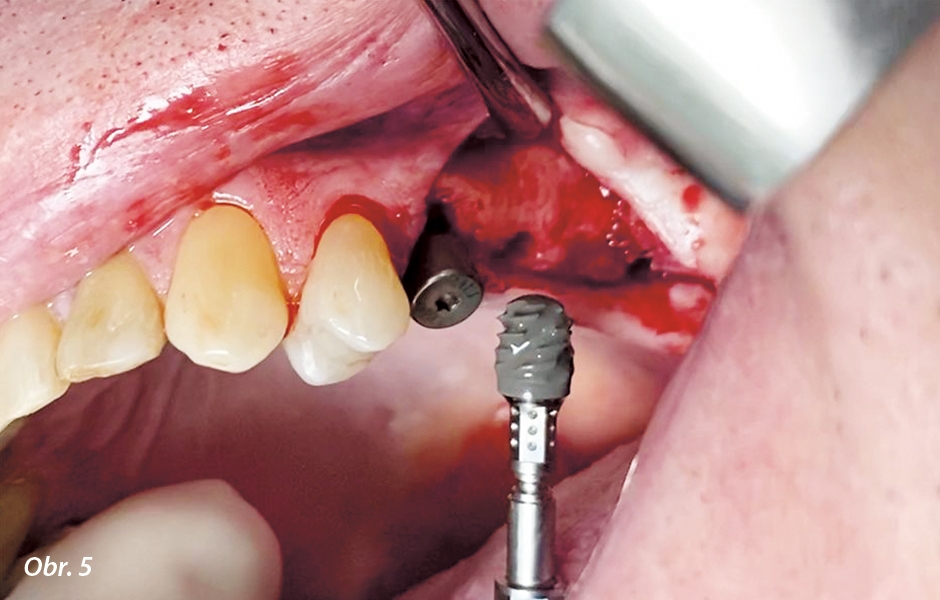 Implantát Straumann® BLX Ø 5.0 mm × 6 mm připravený k zavedení do oblasti zubu 26.