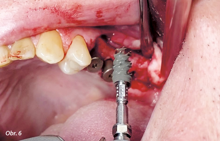 Implantát Straumann® BLX Ø 5.0 mm x 14 mm připravený k zavedení do oblasti 27.
