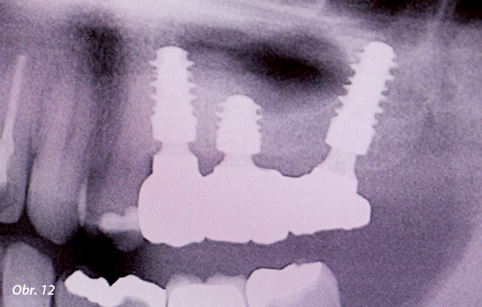 Závěrečné rentgenové vyšetření potvrzující oseointegraci a optimální protetické nasazení.