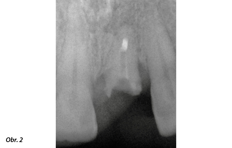 Okamžité zatížení implantátu po extrakci ve vysoce estetické oblasti