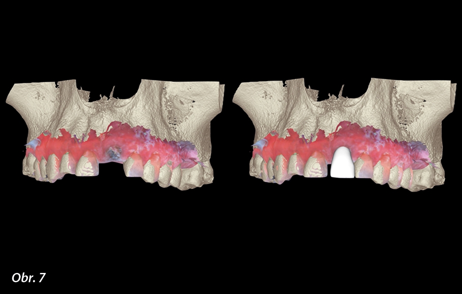 Okamžité zatížení implantátu po extrakci ve vysoce estetické oblasti