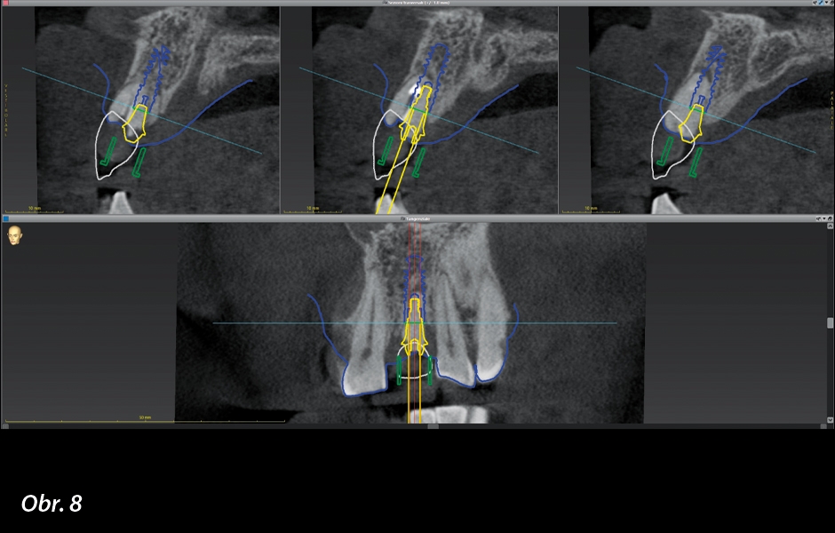 Okamžité zatížení implantátu po extrakci ve vysoce estetické oblasti