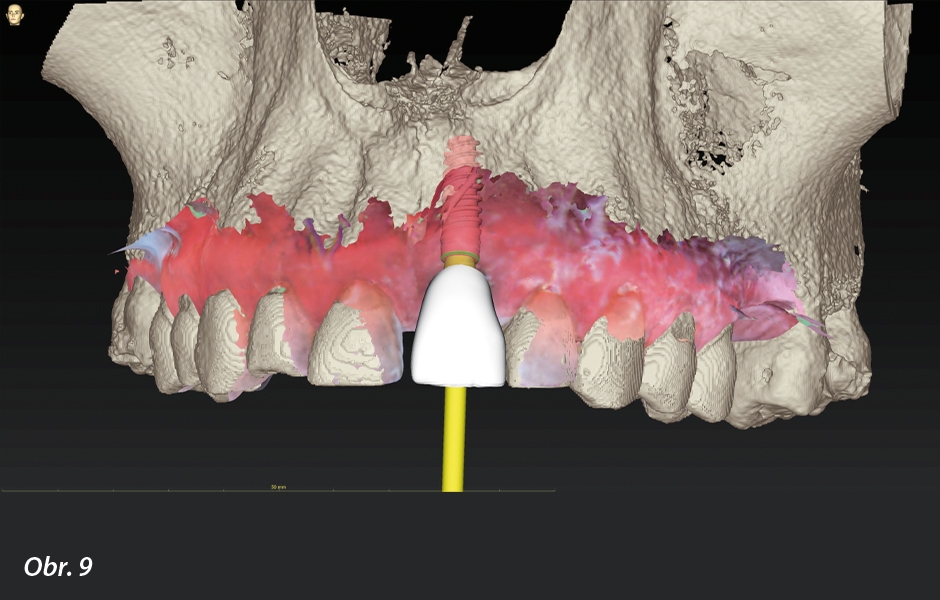 Okamžité zatížení implantátu po extrakci ve vysoce estetické oblasti