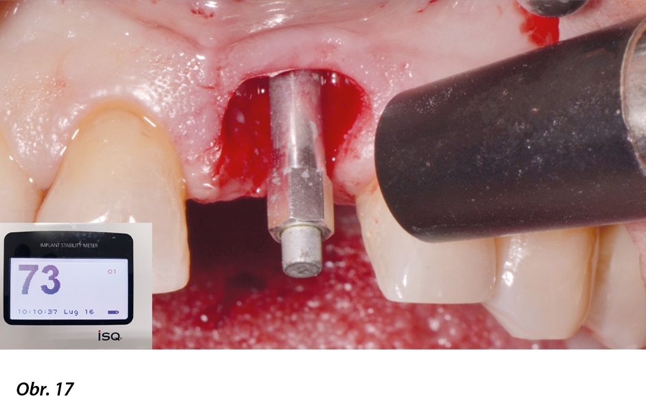 Okamžité zatížení implantátu po extrakci ve vysoce estetické oblasti