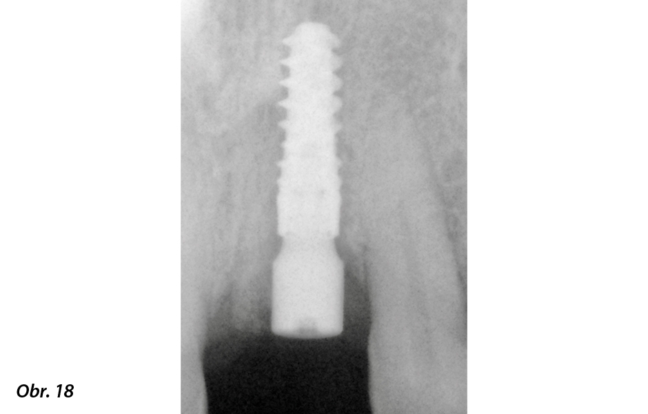 Okamžité zatížení implantátu po extrakci ve vysoce estetické oblasti