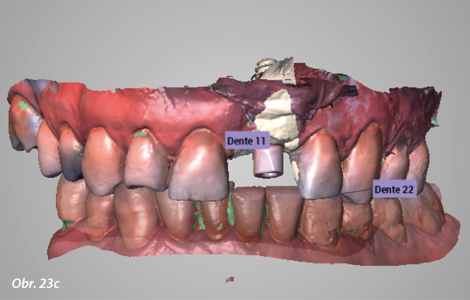 Okamžité zatížení implantátu po extrakci ve vysoce estetické oblasti