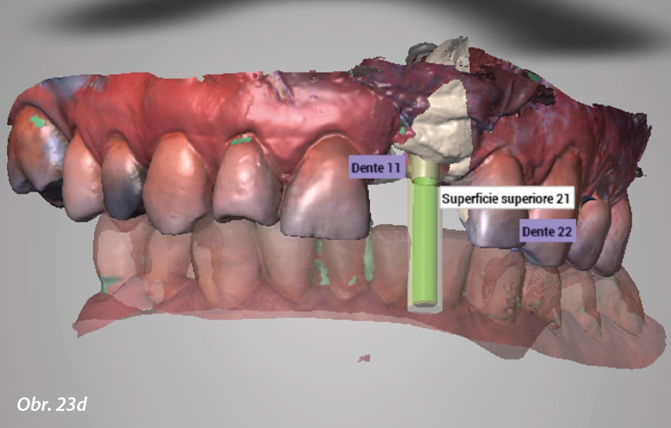 Okamžité zatížení implantátu po extrakci ve vysoce estetické oblasti