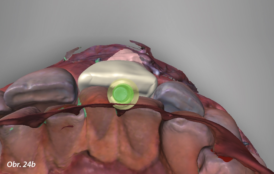 Okamžité zatížení implantátu po extrakci ve vysoce estetické oblasti