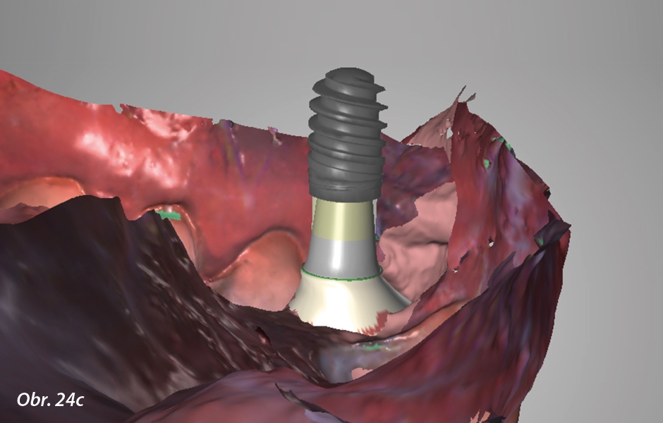 Okamžité zatížení implantátu po extrakci ve vysoce estetické oblasti