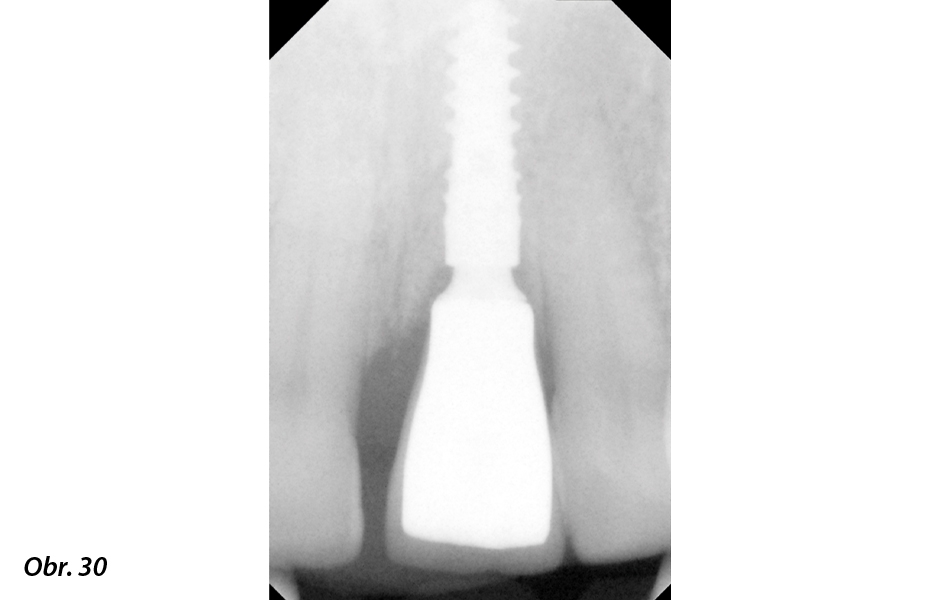 Okamžité zatížení implantátu po extrakci ve vysoce estetické oblasti