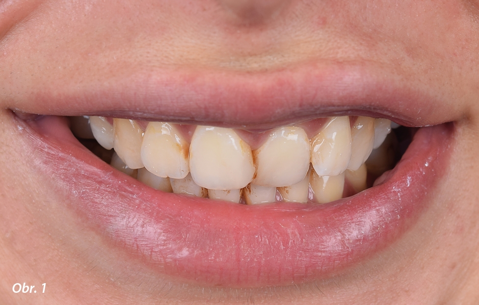 Mladá pacientka nebyla spokojena se vzhledem svých frontálních zubů.