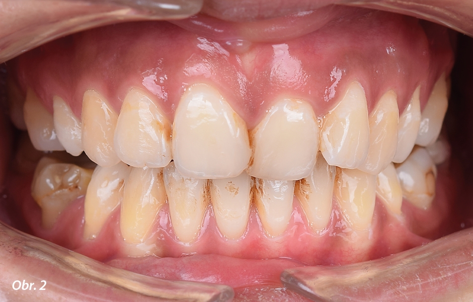 Stěsnané a nepravidelně postavené frontální zuby v horní čelisti.