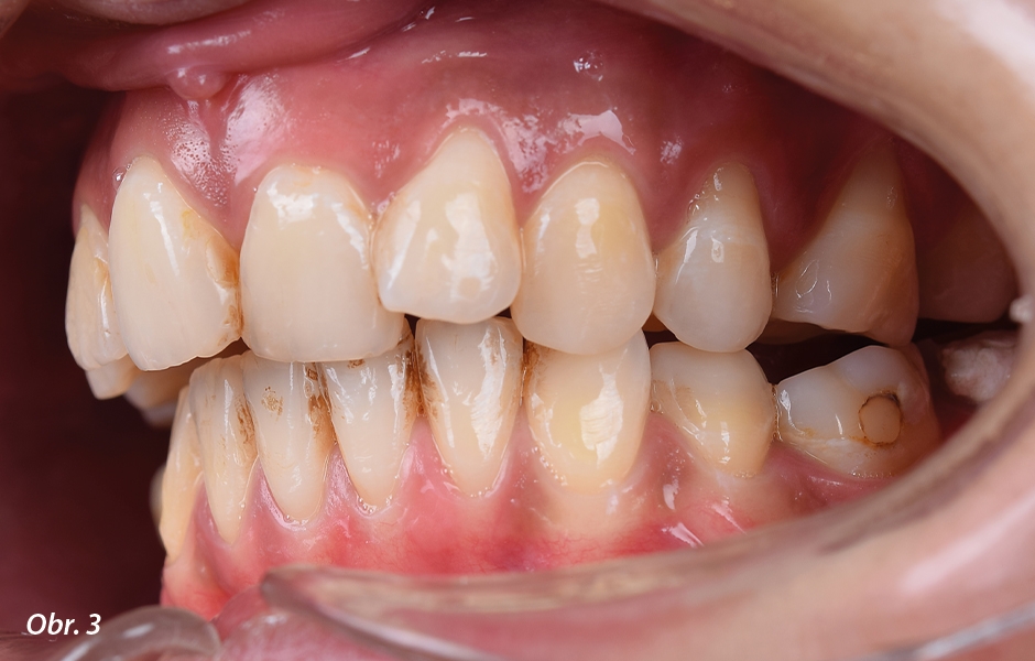 Zub 21 byl sklopen výrazně palatinálně – průběh incizní hrany působil zcela disharmonicky s průběhem horního rtu.
