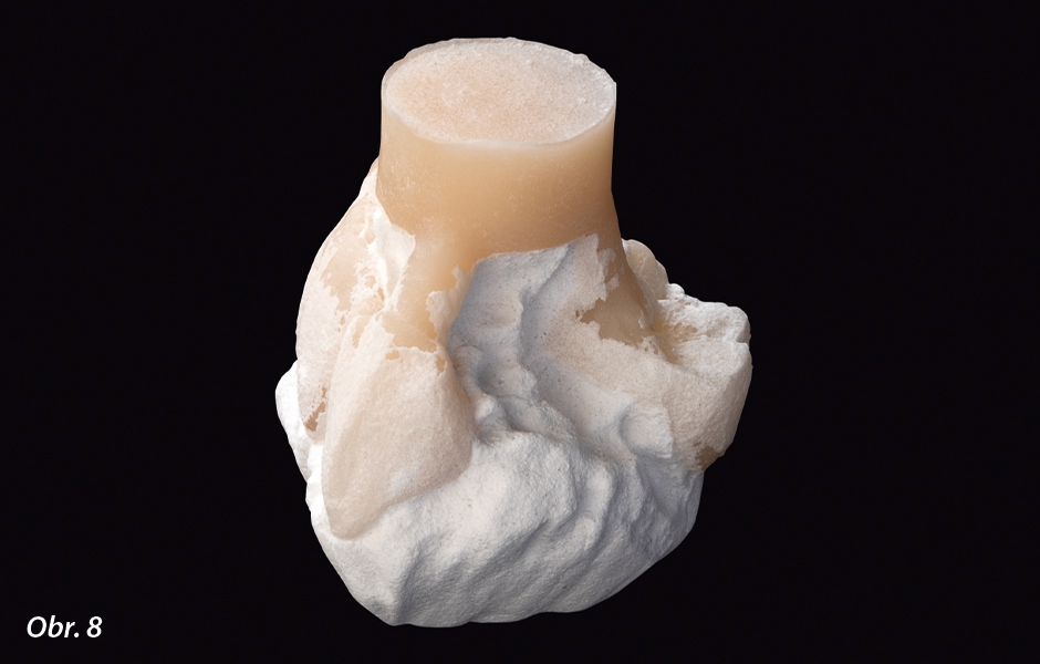 Zatmelovací hmota VITA AMBRIA INVEST celkově zajišťuje absolutně minimální reakční vrstvu s povrchem presované keramiky.