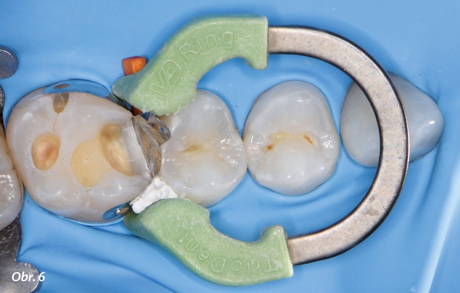 Situácia po naleptaní tvrdých zubných tkanív kyselinou fosforečnou.