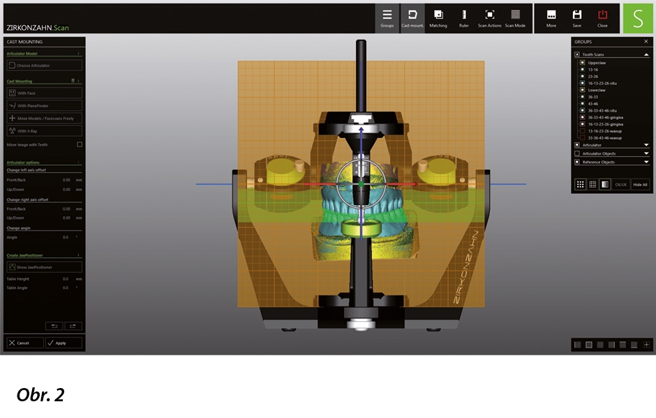 Prototyp náhrad na virtuálním artikulátoru. Skeny pracovních modelů a otisky opotřebených snímatelných náhrad posloužily k nastavení artikulátoru a stanovení správného vertikálního rozměru nových náhrad.