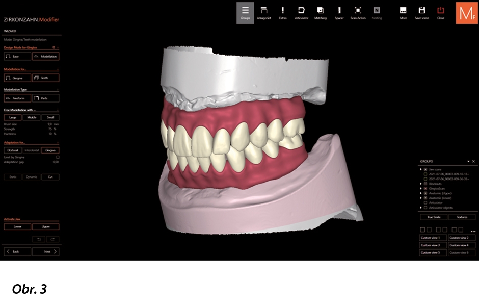 V softwaru Zirkonzahn.Modifier byly anatomie zubu vybrány z dostupných virtuálních knihoven. Gingiva byla softwarem po identifikaci krčků zubů přidána automaticky, takže uživatel musel provést pouze minimální úpravy.