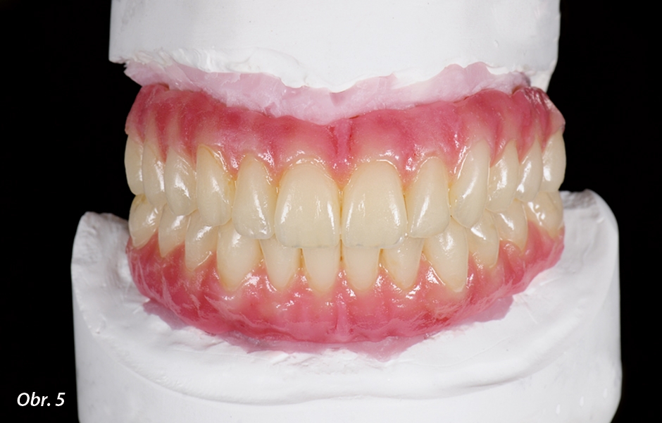 Po úpravě tvaru a textury povrchu náhrad a jejich spojení s implantáty byly prototypy připraveny k frézování z pryskyřice a poté k vyzkoušení v zubní ordinaci.