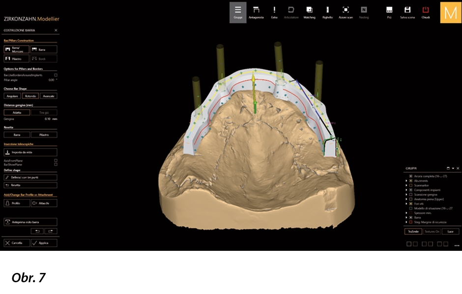 Pomocí pokročilých možností zobrazuje software Zirkonzahn.Modellier různé body a linie na suprakonstrukcích a umožňuje posun primární struktury do různých pozic.