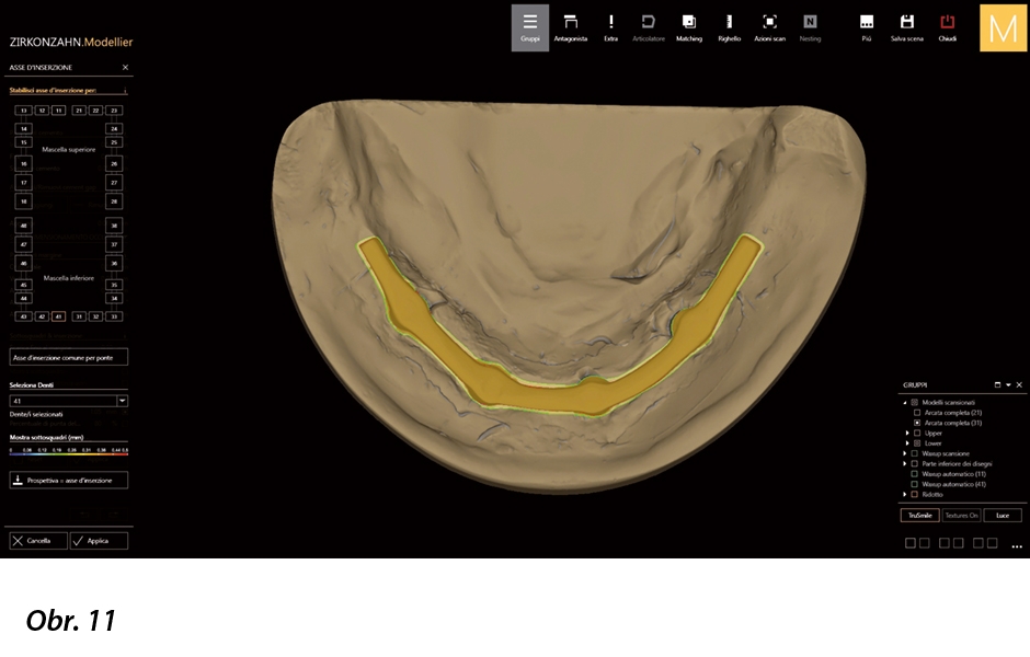 Určení gingiválního okraje a osy nasazení náhrady.