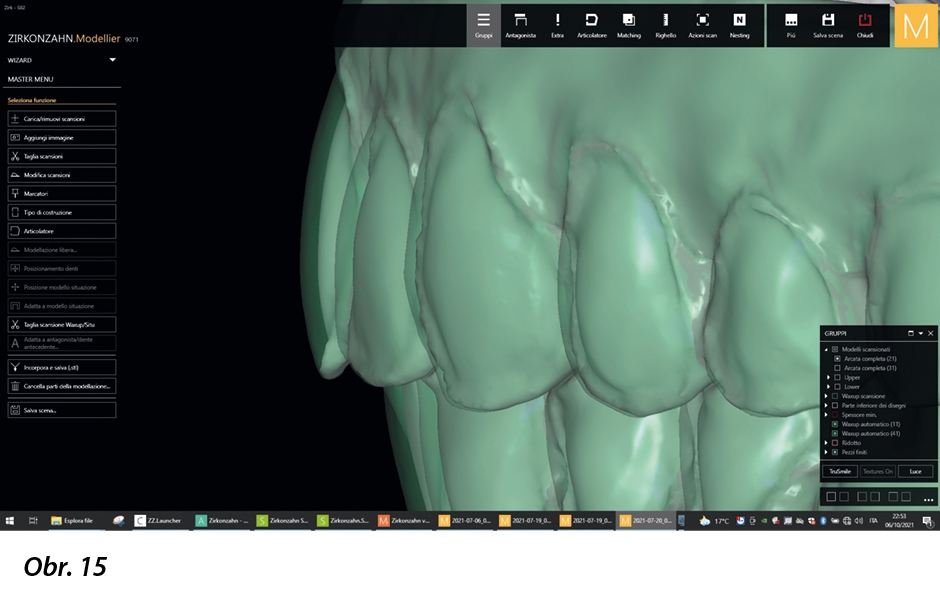 Digitální redukce předních zubů v nefunkčních oblastech pro vrstvení keramiky.