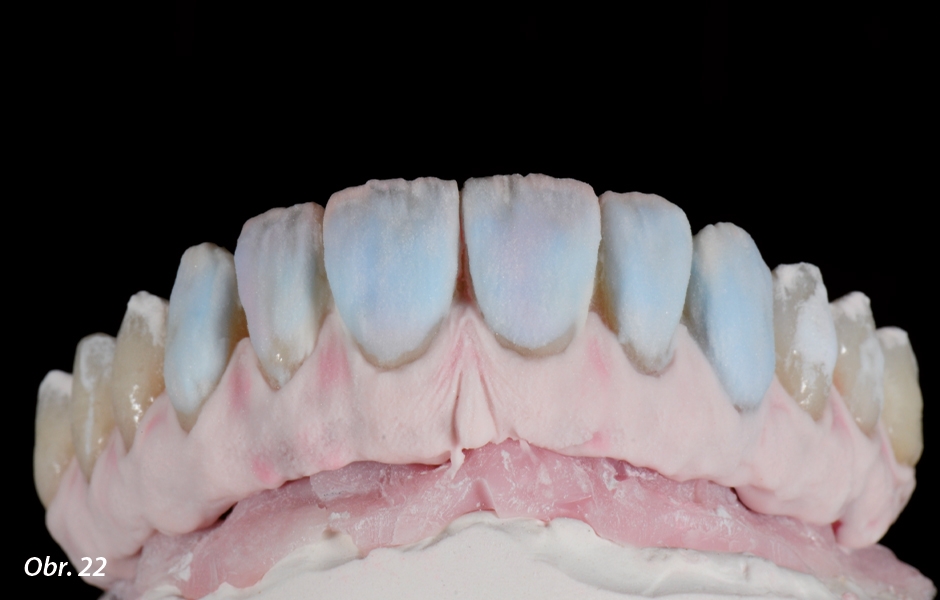 Druhá vrstva ICE Ceramics nanesená na vestibulární oblasti za účelem strukturování tvaru zubů.