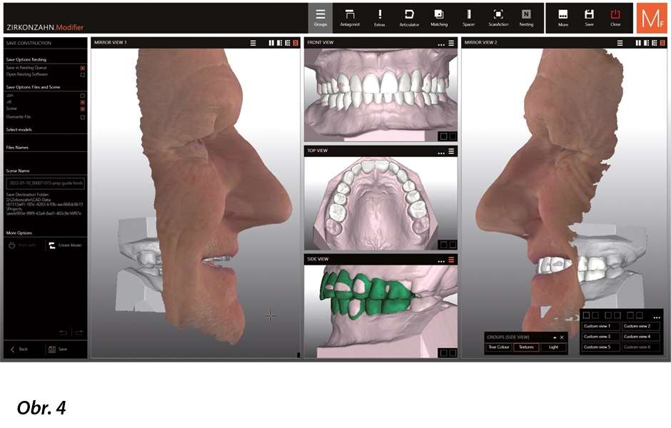 Digitální výstavba zubů za použití knihovny zubů Heroes Collection v softwaru Zirkonzahn.Modifier (funkce Multiview).