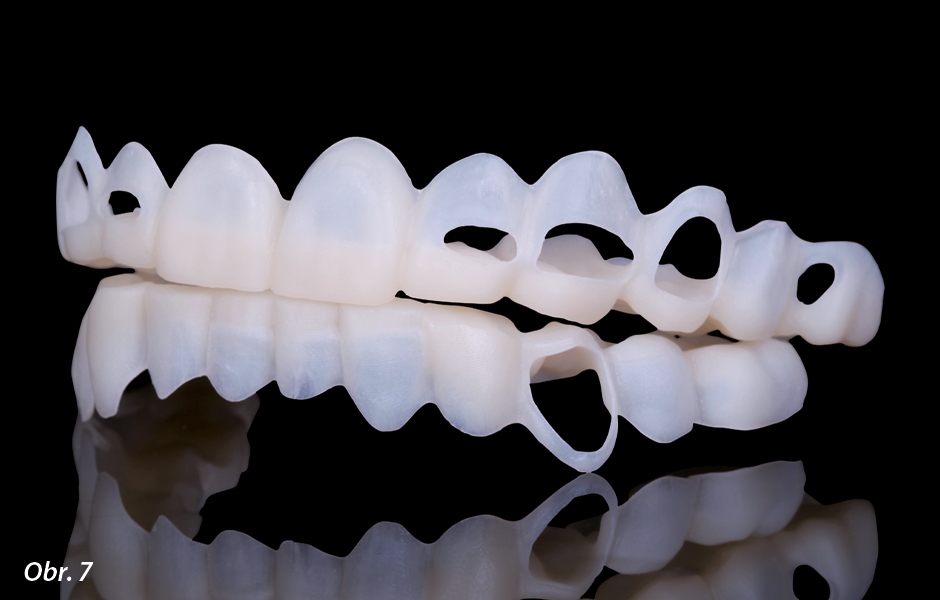 Šablona pro preparaci. Návrh preparace zubů od zubního technika zubnímu lékaři pro maximálně šetrnou preparaci v rámci miniinvazivního ošetření.