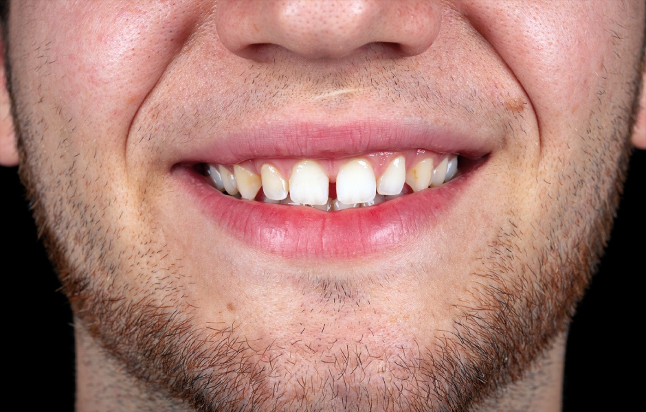 Obr. 1: Výchozí situace: diastema mezi zuby 11 a 13 a dentoalveolární disharmonie charakterizovaná nepoměrem mezi velikostí alveolárního hřebene a velikostí zubů.