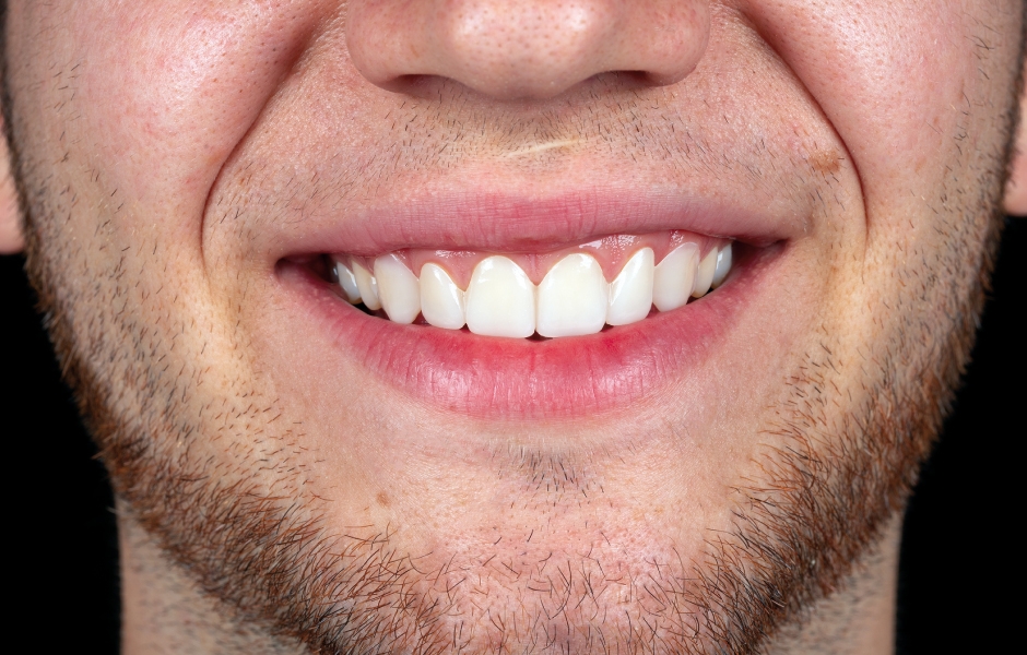 Obr. 21: Finální mock-up jako dočasná náhrada v ústech pacienta.