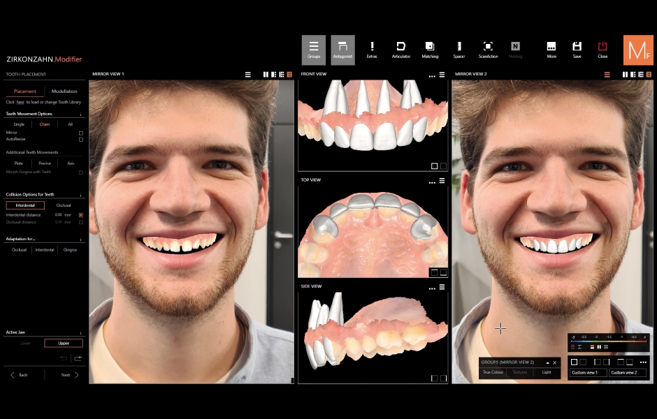 Obr. 7a, b: Intraorální skeny jsou kombinovány s knihovnami zubů s kořeny. Několik setupů dostupných v softwaru má různou morfologii, aby bylo možno vybrat nejvhodnější sadu pro konkrétního pacienta.