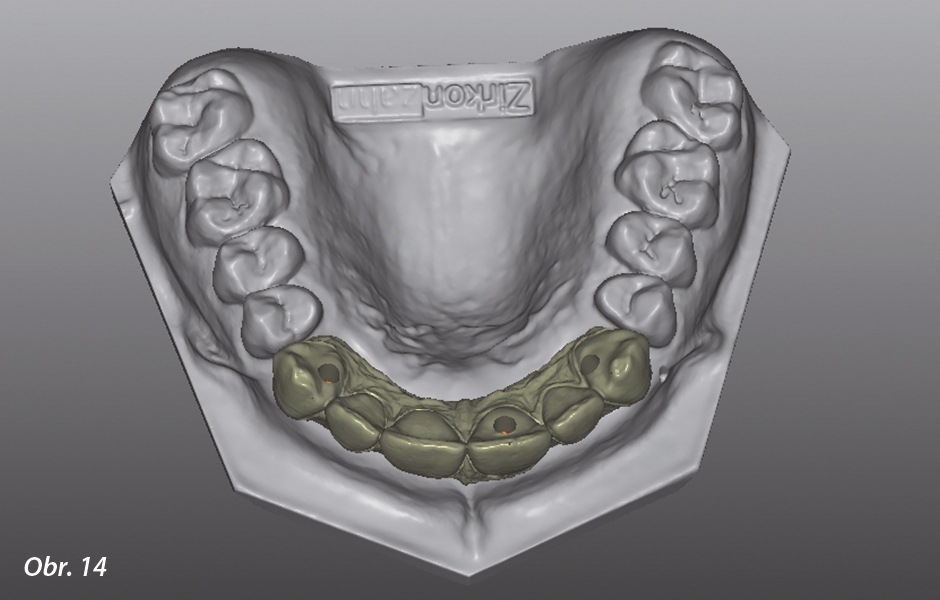 Vhodnou orientací otvorů pro šroubek kompenzují titanové báze K80 Angled Screw Channel (ASC) neoptimální pozice implantátů.