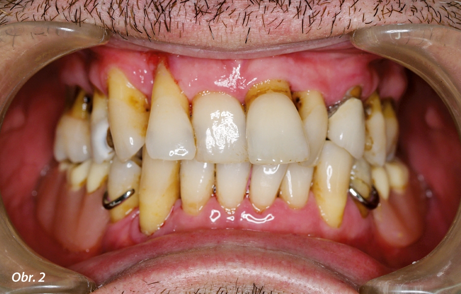 Počáteční situace: Závažná parodontitida, migrace zubů a bolest při dotyku způsobovala pacientovi psychické potíže.