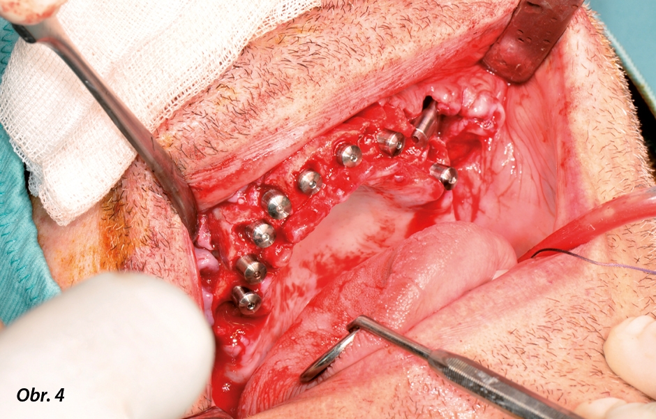 Zubní lékař penetroval kost pomocí speciálního chirurgického nástroje za účelem zavedení zygomatického implantátu.
