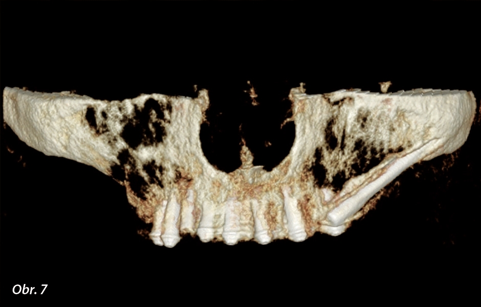 3D pohled na pozice implantátů v plánovacím softwaru.